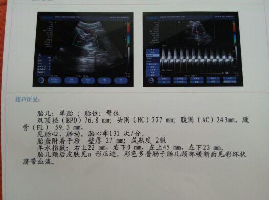 胎儿偏小一个月怎么办？全方位解读解决方案